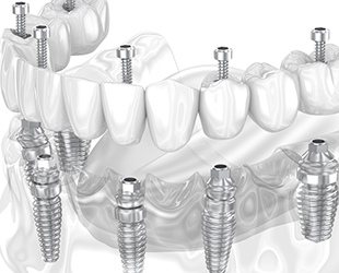 Beyond Straight Teeth: Discovering Orthodontic Innovations in Hervey Bay