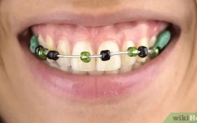 DIY Braces: The Risks and Why You Should Avoid Them