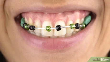 DIY braces