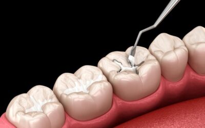 Why Composite Fillings Are the Preferred Choice for Aesthetic Dental Care