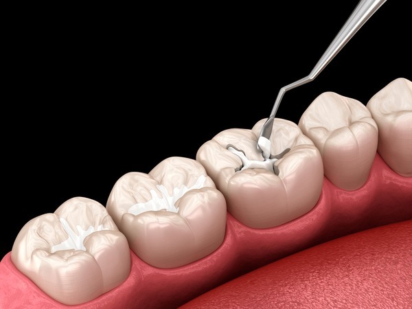 Composite Fillings